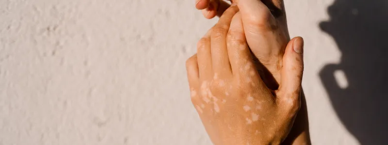 Living With Confidence: Managing Vitiligo