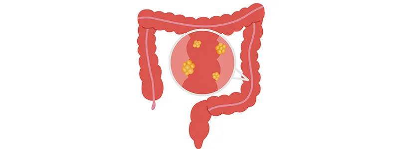 The Rising Concern of Early-Onset Colorectal Cancer in Pakistan