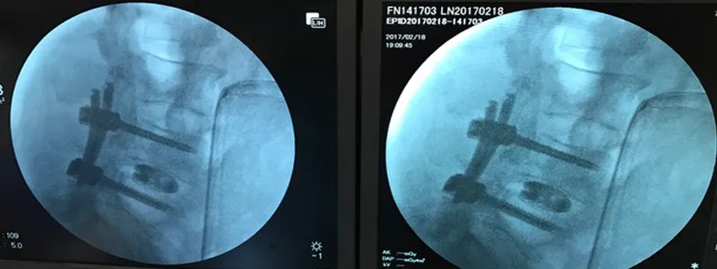 First Minimally Invasive Surgery at AKUH