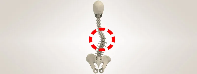 International Scoliosis Day
