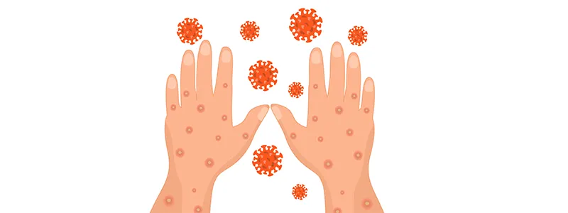 Mpox Outbreaks in Pakistan: A Crucial Test for the National Healthcare System