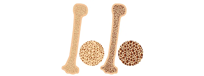 Fragile Bones, Hip Fractures and Care of Elderly