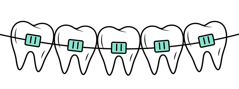 A World of Smiles! Aesthetic and Functional Teeth and Jaws with Orthodontic (Braces) Treatment