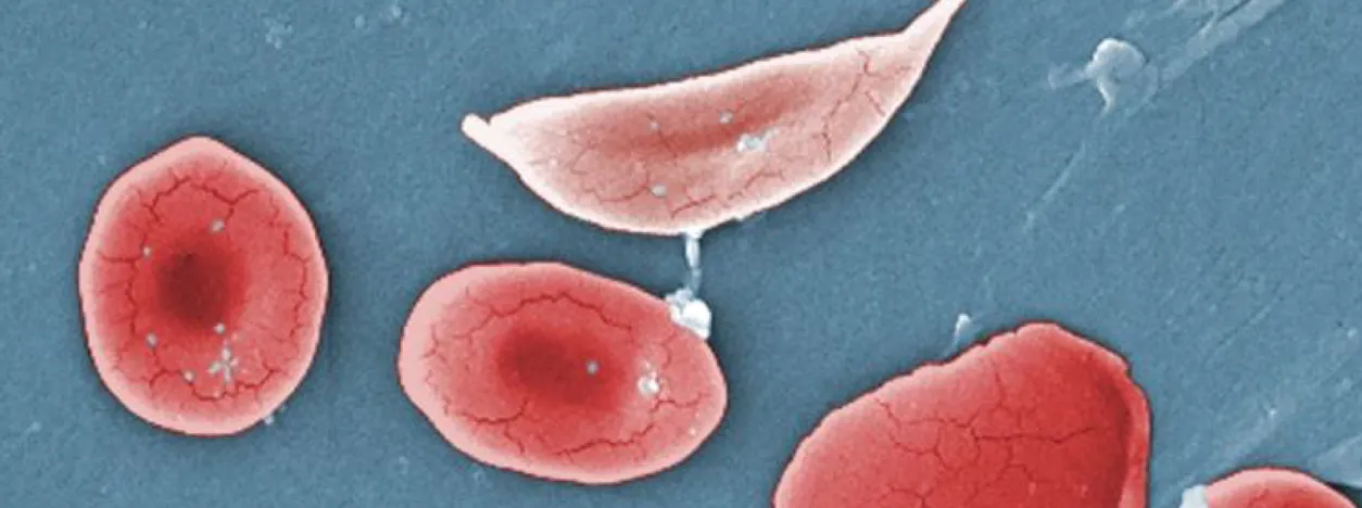 World Sickle Cell Day 2018