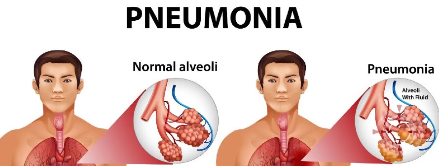 Protect yourself from pneumonia